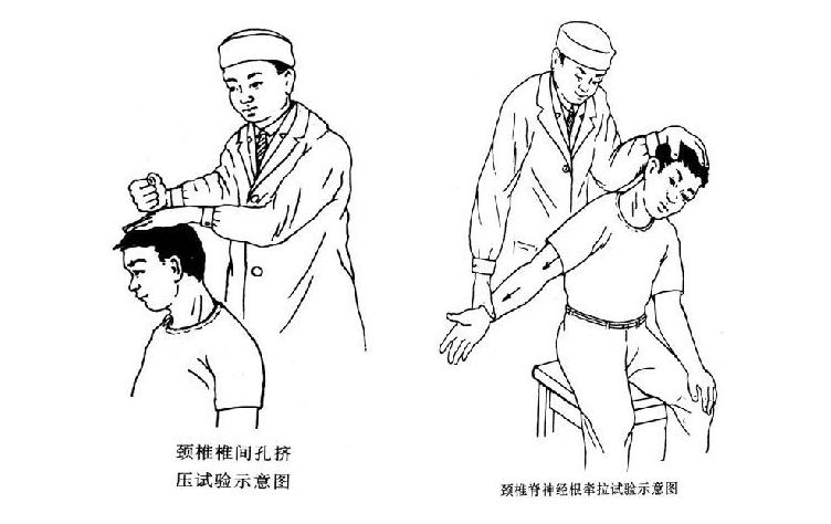 颈舒颗粒:神经根型颈椎病康复护理