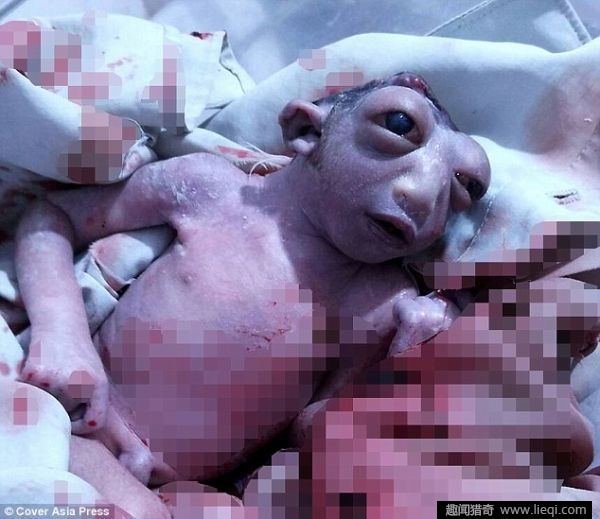 印度女婴出生半颗头颅双眼凸出像外星人(1)