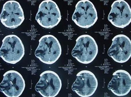 灰指甲真菌可导致颅内感染,医生建议口服丁克