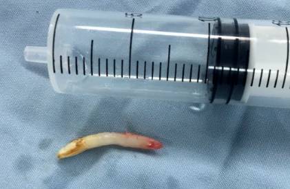 8岁男孩长期鼻塞流鼻涕 检查发现鼻腔内长出牙