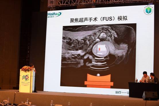 直播聚焦超声手术治疗子宫肌瘤,玩出新高度!_