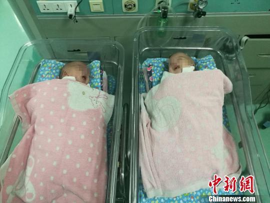 广西一对腹部连体男婴出生41天后成功分离 align=center