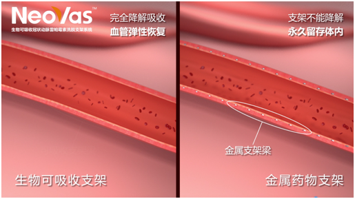 可降解支架:为"堵心"冠心病患者点亮希望之光