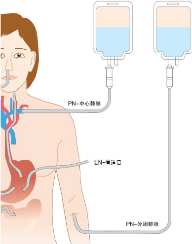 肠内营养滴剂_