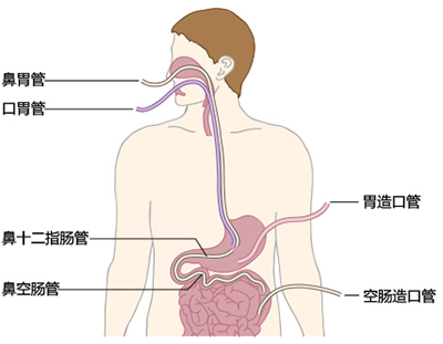 肠内肠外营养ppt_肠外肠内营养课件ppt