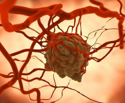 出国就医:早期癌症血液检测技术即将出炉