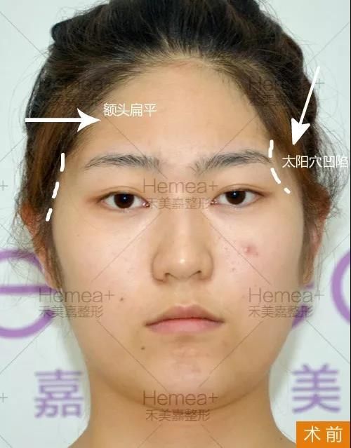 面部颧骨高的改善！