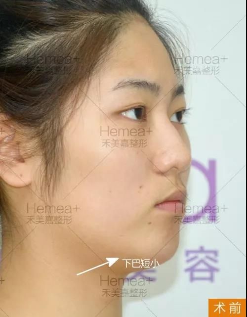 面部颧骨高的改善！