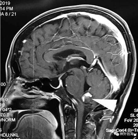 六旬婆婆脑部深处藏脑动脉瘤 医生穿越禁区血管里“拆弹”