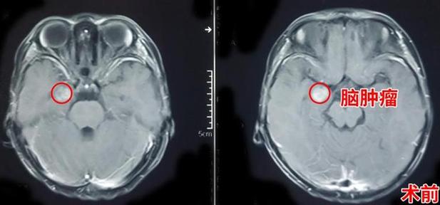 4岁男孩肚子有个“小球球”在跳 没想到是脑肿瘤捣乱