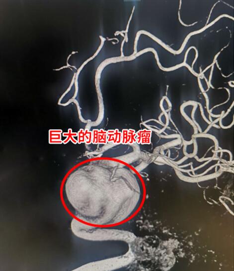 六旬阿姨脑血管长了巨大血泡 取手臂血管颅内外血管搭桥获救