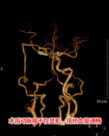六旬阿姨脑血管长了巨大血泡 取手臂血管颅内外血管搭桥获救