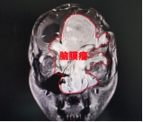 大脑三分之一竟然都是脑膜瘤，藏族少年千里来京生死闯关