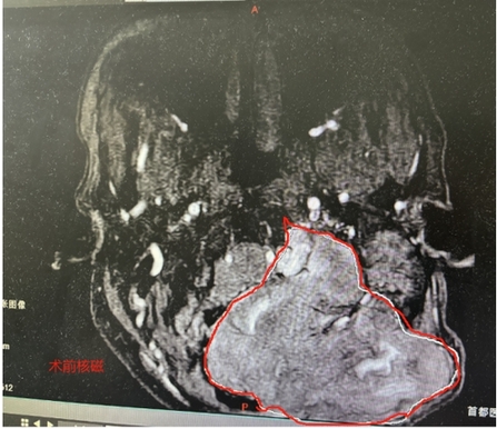 脑瘤诊断证明图片图片