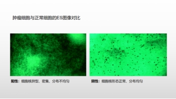 细胞级荧光导引精准技术，突破高级别胶质瘤手术的裸眼限制