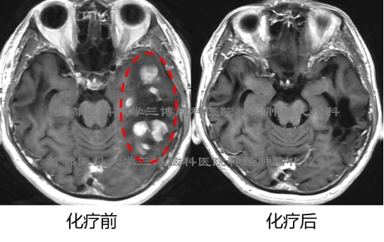 三博脑科张俊平研究成果在第29届美国神经肿瘤年会进行大会口头报告