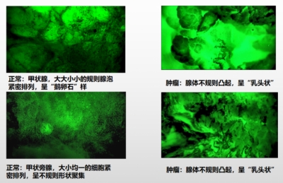 细胞级荧光导引技术EndoSCell®精准平衡甲状腺肿瘤根治性切除与功能保护