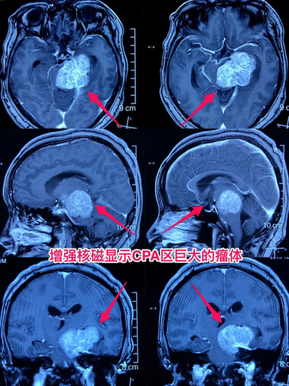 勇闯“生命禁区”，三博专家成功切除脑干脑膜瘤