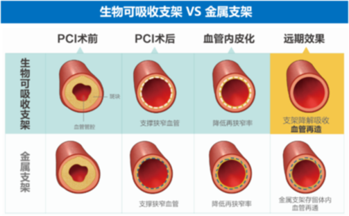 “介入无植入”理念获多方关注，冠心病治疗迎来新风向