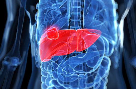 罗氏免疫联合疗法提高肝细胞癌患者的总体生存率