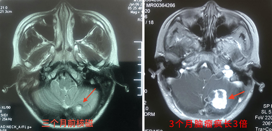 12岁男孩脑瘤3个月疯长3倍 神外专家妙手成功“拆弹”