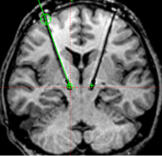 术中磁共振为脑起搏器手术保驾护航