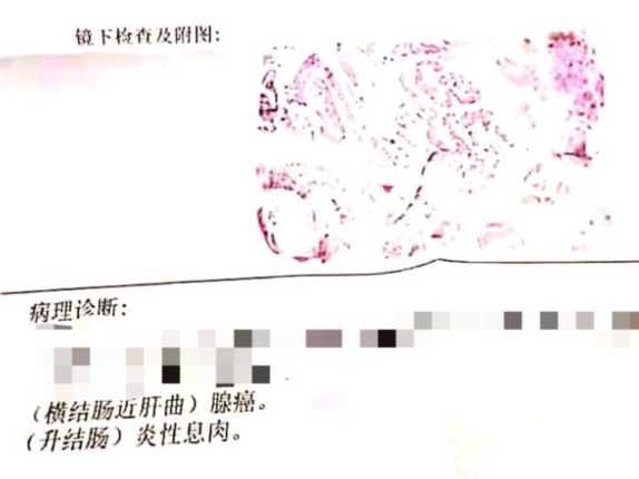 什么原因让一家三代人患上大肠癌