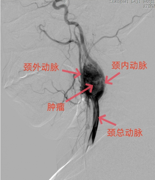 “悬挂在枝头的马蜂窝”——带你了解一下颈动脉体瘤
