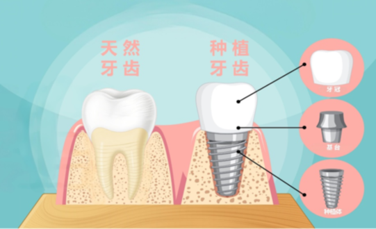 种植牙：口腔里的“新牙”养成记与守护攻略