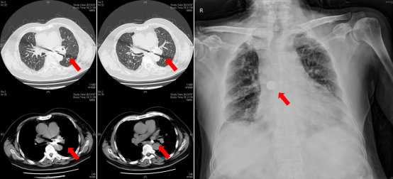 警惕餐桌上的隐形杀手：气管异物，这些救命知识必须掌握