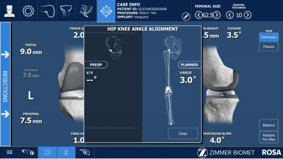 智能科技赋能:膝关节置换手术实现高效精准突破 智能科技赋能:膝关节置换手术实现高效精准突破