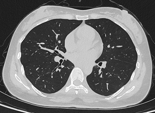 光子计数能谱CT:降低辐射,为患者健康体检“护航” 光子计数能谱CT:降低辐射,为患者健康体检“护航”