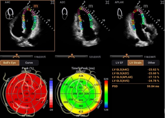 自动左心室应变评估 Auto Strain LV，让心肌应变检测不再需要心电图的“入场券”