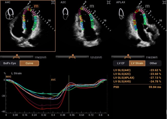 自动左心室应变评估 Auto Strain LV，让心肌应变检测不再需要心电图的“入场券”